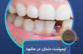 ایمپلنت دندان در مشهد  با اقساط بلندمدت و شرایط ویژه